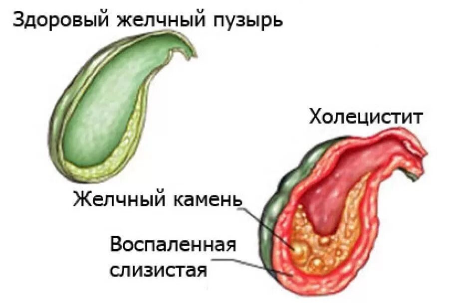 Симптомы желчного пузыря форум