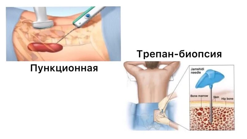 Иглы для биопсии 14g. Биопсия мягких тканей. Воспаление скелетных мышц – миозит;. Инструментальная мобилизация мягких тканей iastm. Биопсия исследование материала.