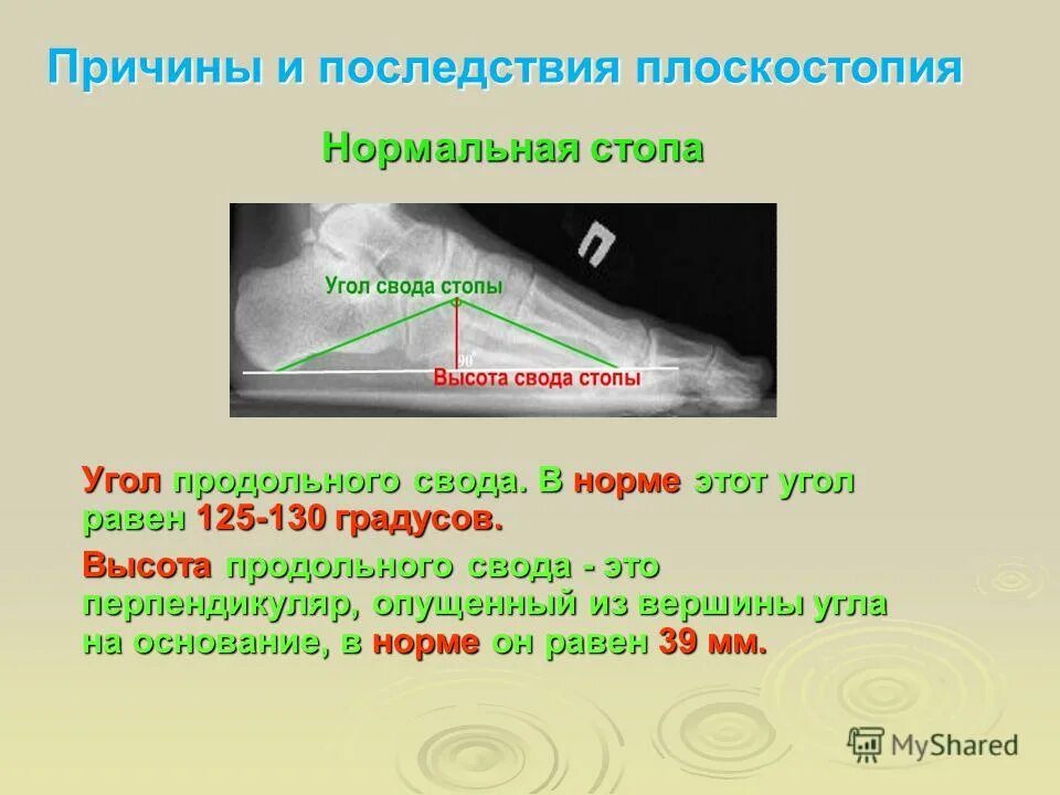 угол продольного свода стопы. плоскостопия угол свода. плоскостопие угол свода стопы. плоскостопия угол свода. продольное плоскостопие рентген стадии.