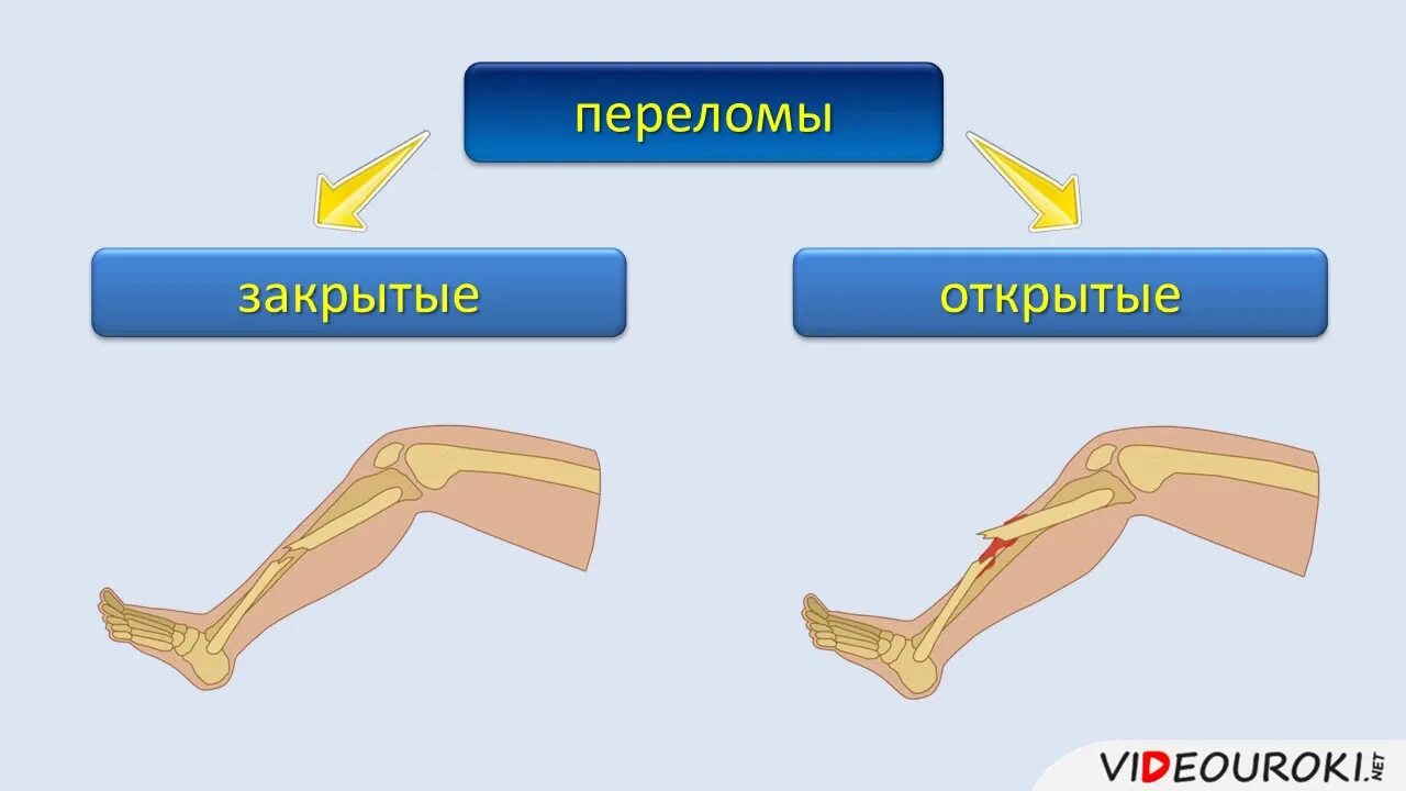 Закрытые и открытые повреждения. Открытые и закрытые передома. Открытый и закрытый перелом. Открытые и закрытые травмы.