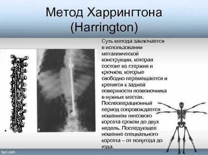 Сколиоз метод