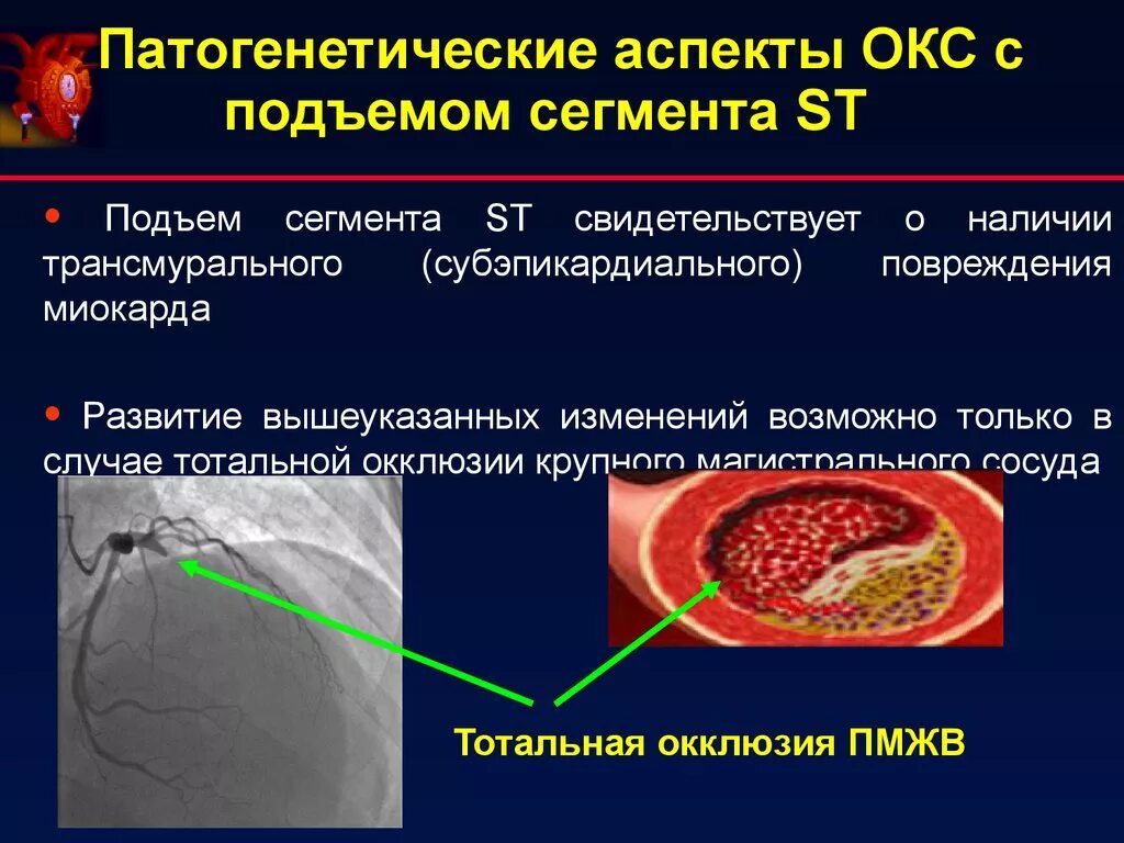 Острый коронарный синдром инфаркт. Коронарный синдром на ЭКГ. Острый коронарный синдром с подъемом St. Острый коронарный синдром без подъема сегмента St патогенез. Острый коронарный синдром презентация.