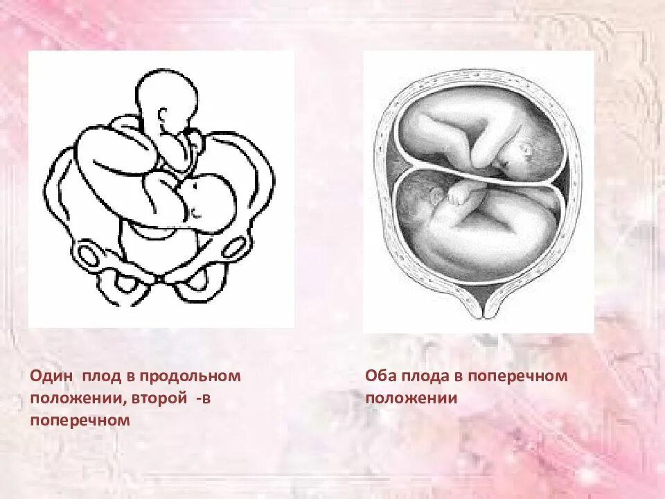 Положение плода поперечное головное. Поперечное предлежание плода. Продольное и поперечное положение плода. Поперечное предлежание двойни. Позиция плода при поперечном положении