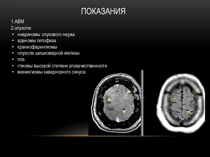 Менингиома головного мозга классификация. Менингиома кавернозного синуса кт. Невринома зрительного нерва кт.