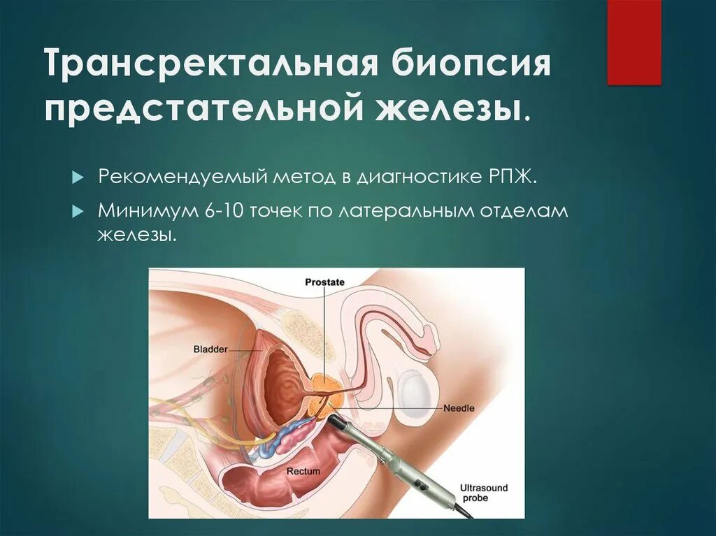 Как берут биопсию у мужчин. Трузи (трансректальное ультразвуковое исследование). Прибор для биопсии предстательной железы. Трансперинеальная биопсия предстательной железы. Трансректальная биопсия простаты.