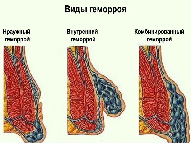 Боли внутри заднего прохода. Тромбированный внешний узел геморрой. Перианальный геморрой. Внешний наружный геморрой.