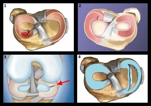 Повреждение мениска коленного сустава по stoller. Повреждение медиального рога мениска Stoller 3. Разрыв мениска коленного сустава 1 степени. Передний и задний Рог медиального мениска коленного сустава.