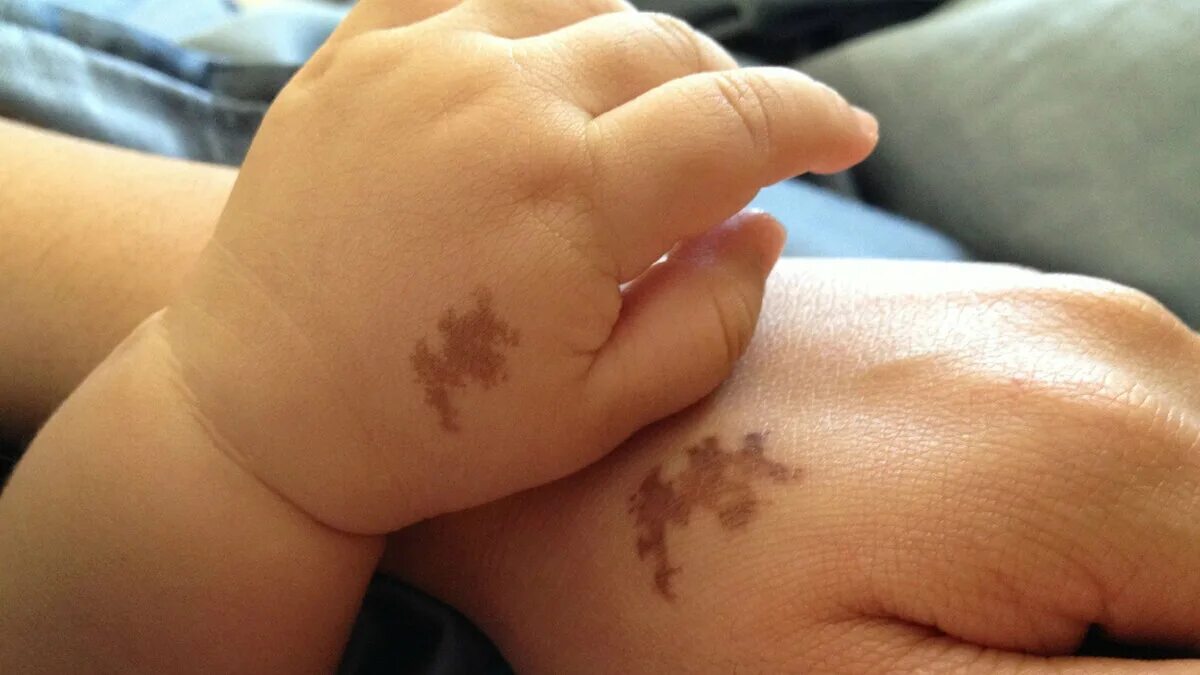 Что означает пятно. Что означает пятно. Меланоцитарный невус беккера. Меланома кожи формы роста. Появление пигментации на коже.