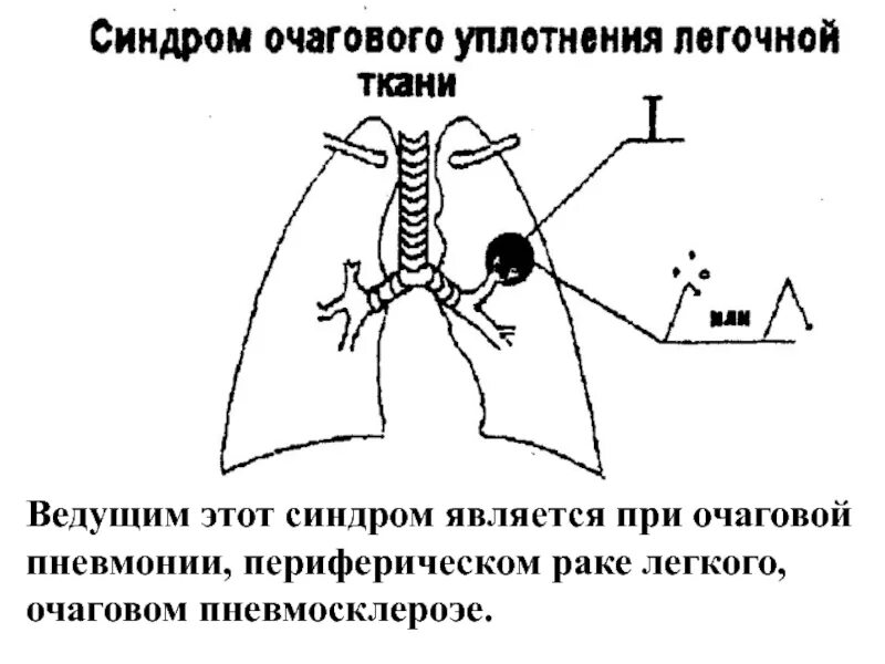 Синдром уплотнения ткани. Синдром очагового уплотнения легочной ткани. очаговое уплотнение легочной ткани пропедевтика. синдром уплотнения легочной ткани перкуссия. синдром очагового уплотнения легкого.
