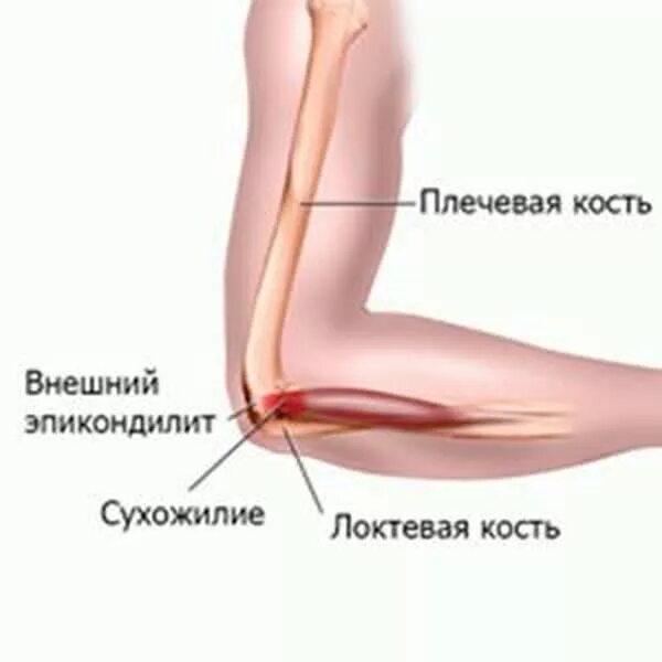 Локтевой сустав мышцы и сухожилия. Надмыщелка локтевого сустава. Эпикондилит локтевого сустава. Связки локтевого сустава. Разрыв локтевого сустава.