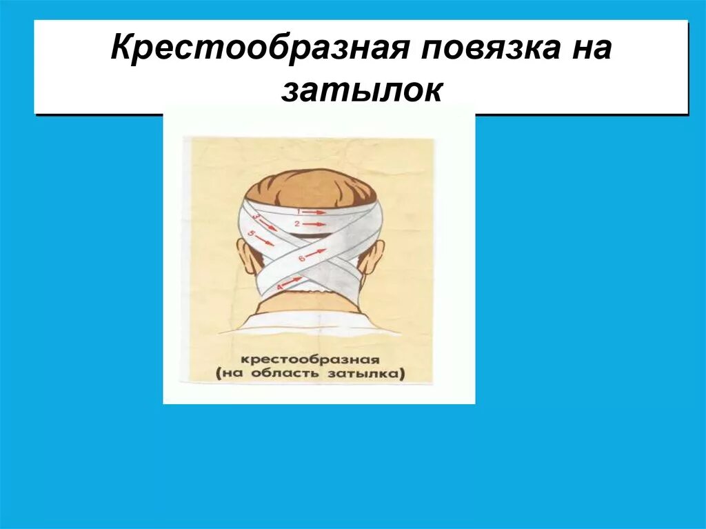 Крестообразная на затылок. Наложение крестообразной повязки на затылок. Наложить повязку крестообразную на затылок алгоритм. Наложение восьмиобразной повязки на затылок. Наложение крестообразной повязки на затылок алгоритм.