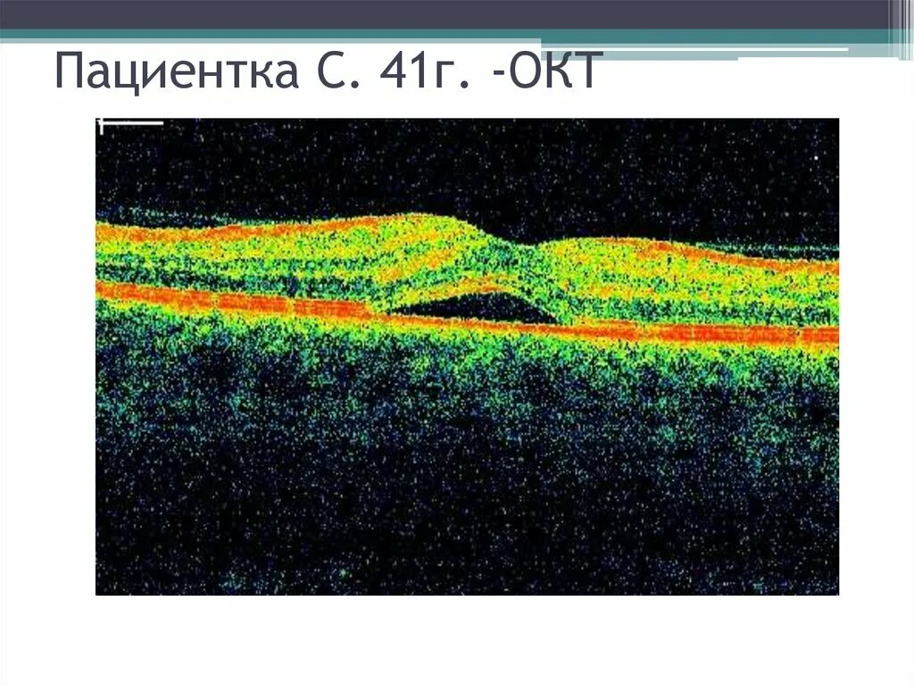 Когерентная томография сетчатки глаза норма. Когерентная томография сетчатки глаза. Оптическая когерентная томография глаза. Толщина роговицы. Оптическая когерентная томография сетчатки.