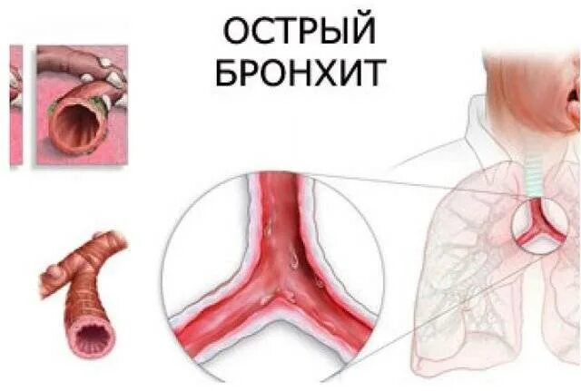 Острый бронхит и хронический бронхит. Острый и хронический бронхит. Хронический бронхит дыхание. Острое воспаление слизистой оболочки бронхов. Заболевания острый бронхит.
