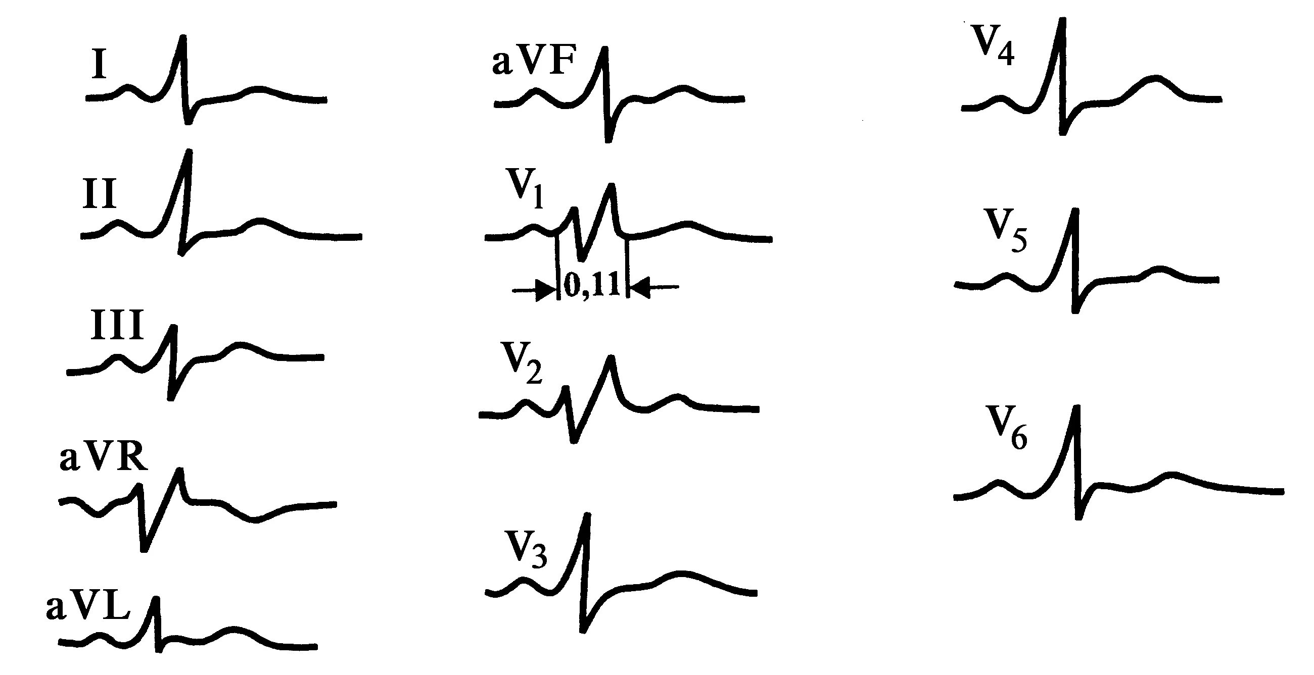 Блокада правой ножки пучка гиса эос. Блокада правой ножки пучка гиса на экг что это на экг. Направление эос. Полная блокада пнпг на экг. Блокада правой ножки пучка гиса эос.