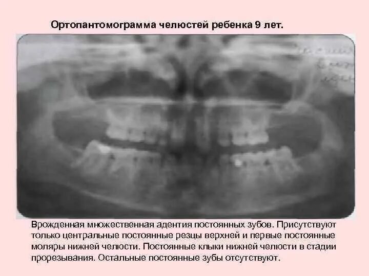 У ребенка нет зачатка постоянного зуба