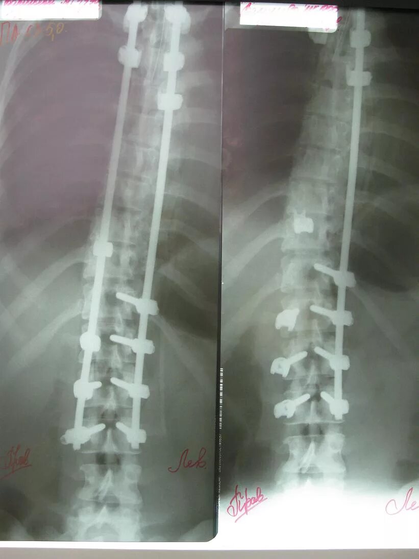 Реабилитация после операции на позвоночнике с металлоконструкций. Титановая металлоконструкция в позвоночнике. Металлическая конструкция для позвоночника. Титановые стержни в позвоночнике.
