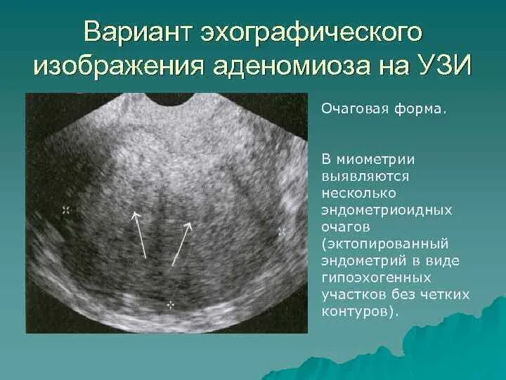 Уз признаки диффузных изменений миометрия