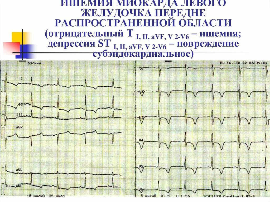 Изменение передней стенки левого желудочка. Признаки ишемии миокарда на ЭКГ. ЭКГ при ишемии передней стенки миокарда. ЭКГ при ишемических изменениях миокарда. ЭКГ при субэпикардиальной ишемии.