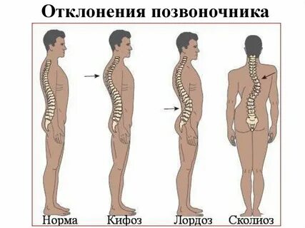 Причины горба на спине