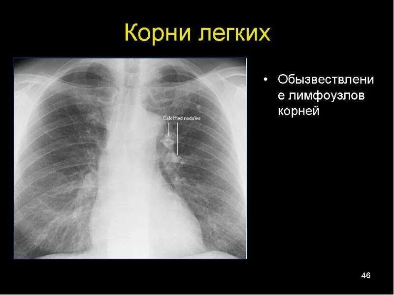 кт увеличенные лимфатические узлы средостения. саркоидоз рентген описание. лимфосаркома на рентгенограммах. лимфоузлы средостения. лимфатические узлы легких.