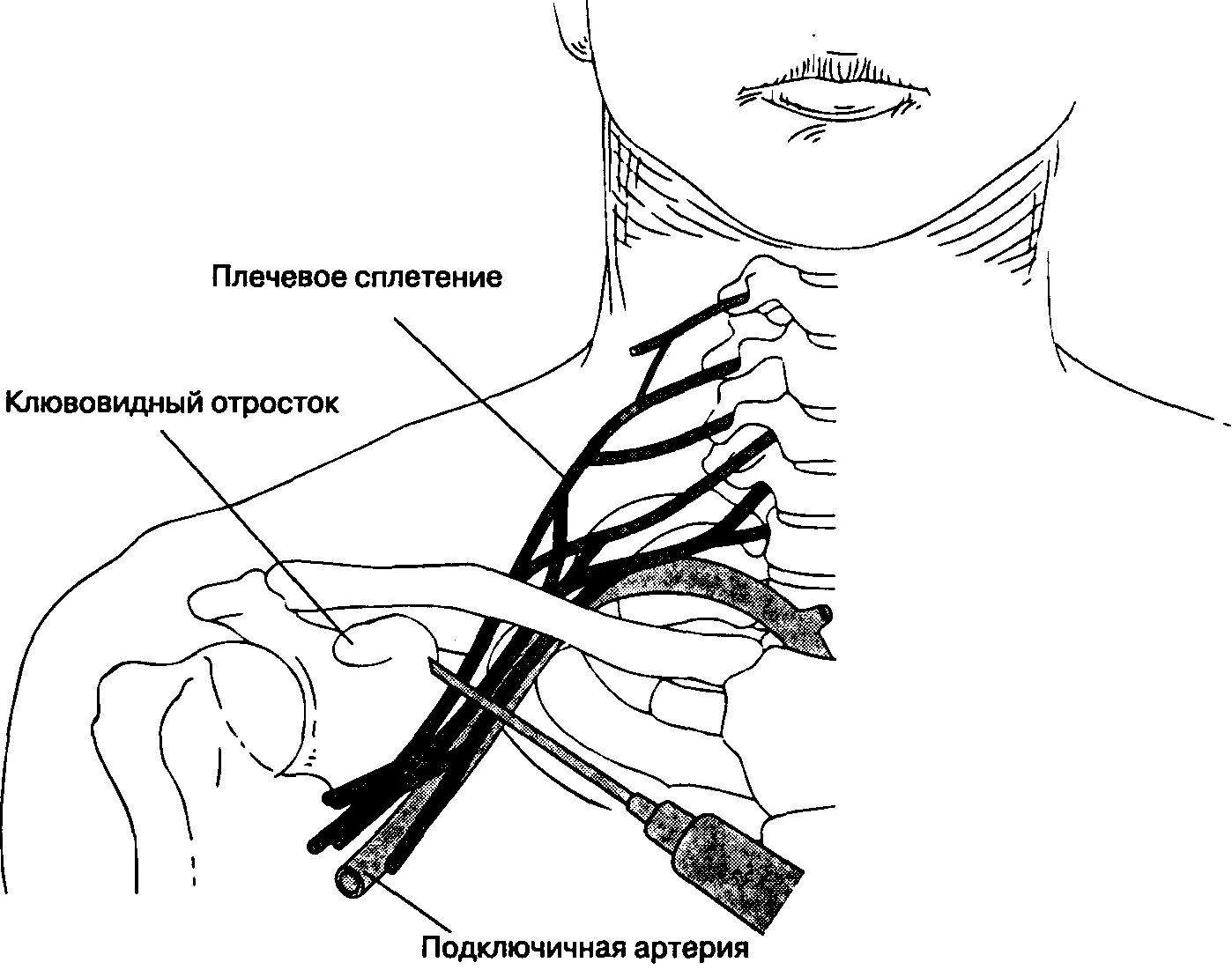 Блокада сплетения. Надключичная блокада плечевого сплетения. Надключичная блокада плечевого сплетения анатомия. Блокада плечевого сплетения по Куленкампфу. Проводниковая анестезия плечевого сплетения.
