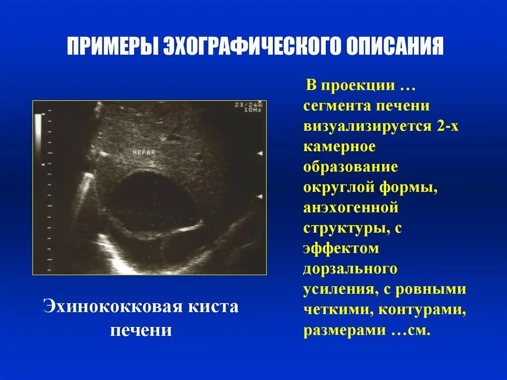 Аваскулярное образование в печени. Анэхогенная структура УЗИ. Анэхогенное аваскулярное образование. Киста в печени анэхогенное образование. Множественные анэхогенные образования.