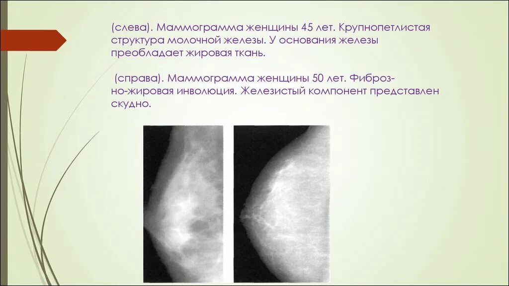 Фиброзно железистая ткань. Молочные железы железистая ткань. Маммография жировая инволюция. Фиброзная инволюция молочных желез маммография.