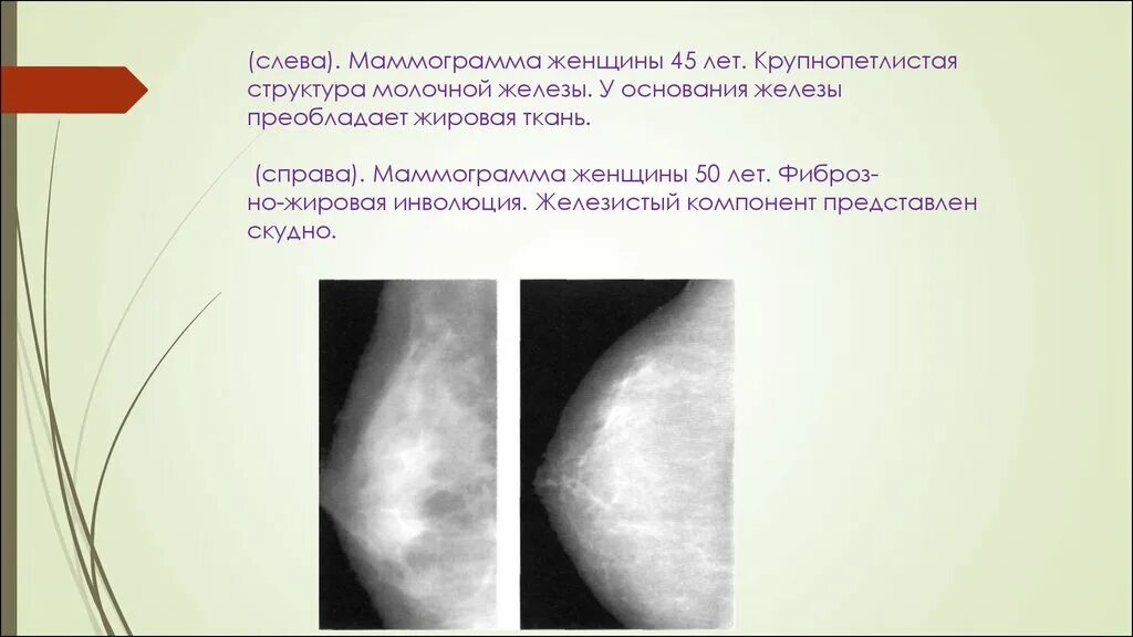 Что означает фиброзное изменение