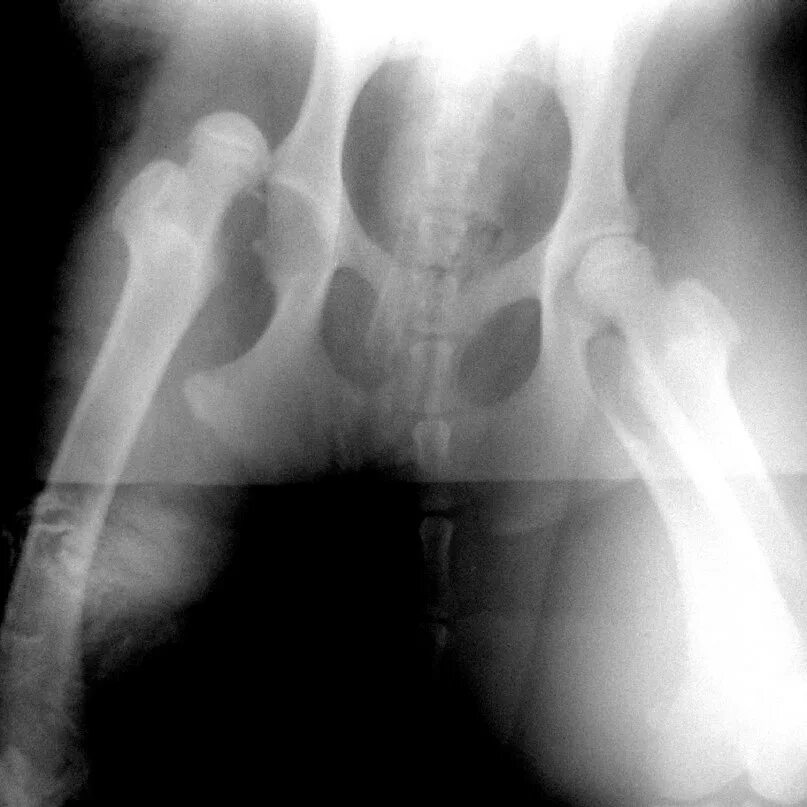 надлобковый вывих бедра рентген. вывих тазобедренного сустава рентген. вывих бедра рентген. врожденный вывих бедра рентген. рентгенограмма тбс вывих.