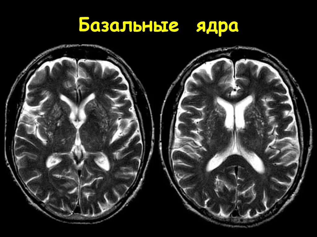 Базальные ядра головного мозга анатомия кт. Хвостатое ядро мрт анатомия. Базальные ганглии анатомия мрт. Базальные ганглии мозга на мрт. Изменение в базальных отделах