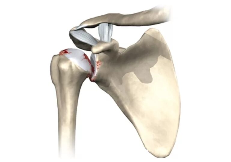 Лечение ключично акромиального артроза. Артроз акромиально-ключичного сочленения плечевого сустава. Остеоартроз акромиально-ключичного сочленения рентген. Артроз акромиально-ключичного сочленения сочленения. Артроз акс плечевого сустава.