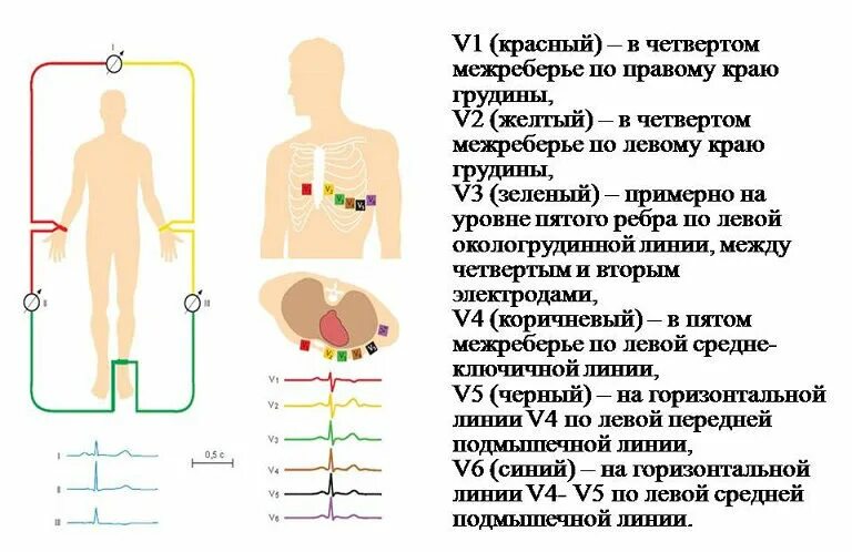 Схема постановки электродов при ЭКГ. Как правильно наложить электроды для снятия ЭКГ. Электроды ЭКГ схема наложения. ЭКГ как устанавливать электроды. Соп экг