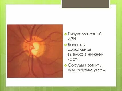 Экскавация зрительного нерва при глаукоме