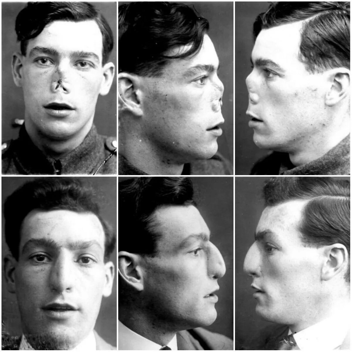 Мировой после. Лица людей после первой мировой войны. Ранения лица первая мировая. Снимки людей до и после войны.