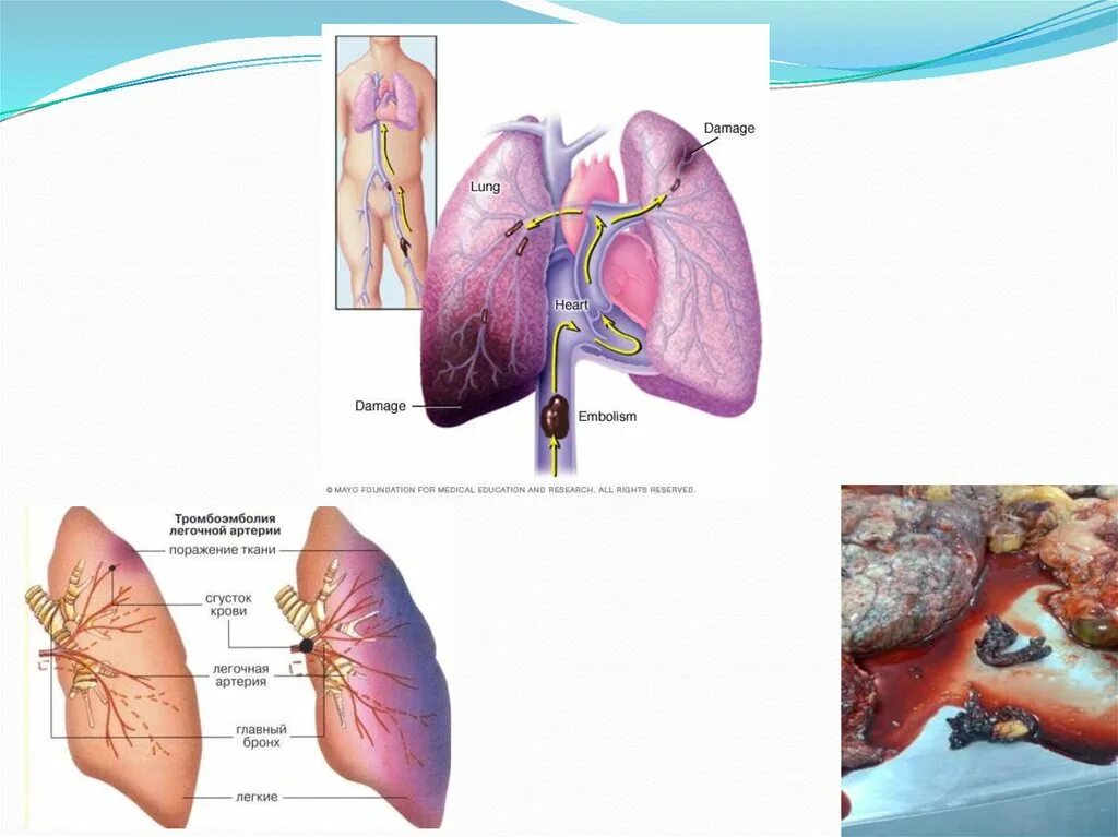 Тромболегочная эмболия. Тромбоэмболия легких патанатомия. Тромбоэмболия легочной артерии (Тэла). Тэла патологическая анатомия.