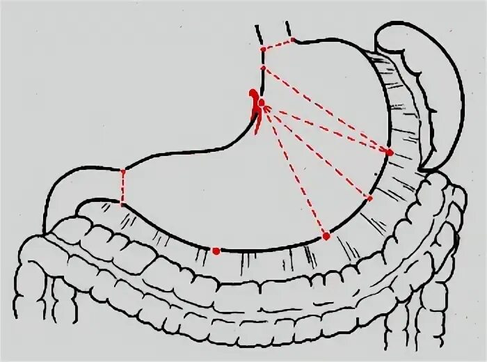 Ушивание желудка картинки принцип. Увлечение желудок операция. Операция желудка картинки маленькие по размеру. Операция удаления опухоли желудка