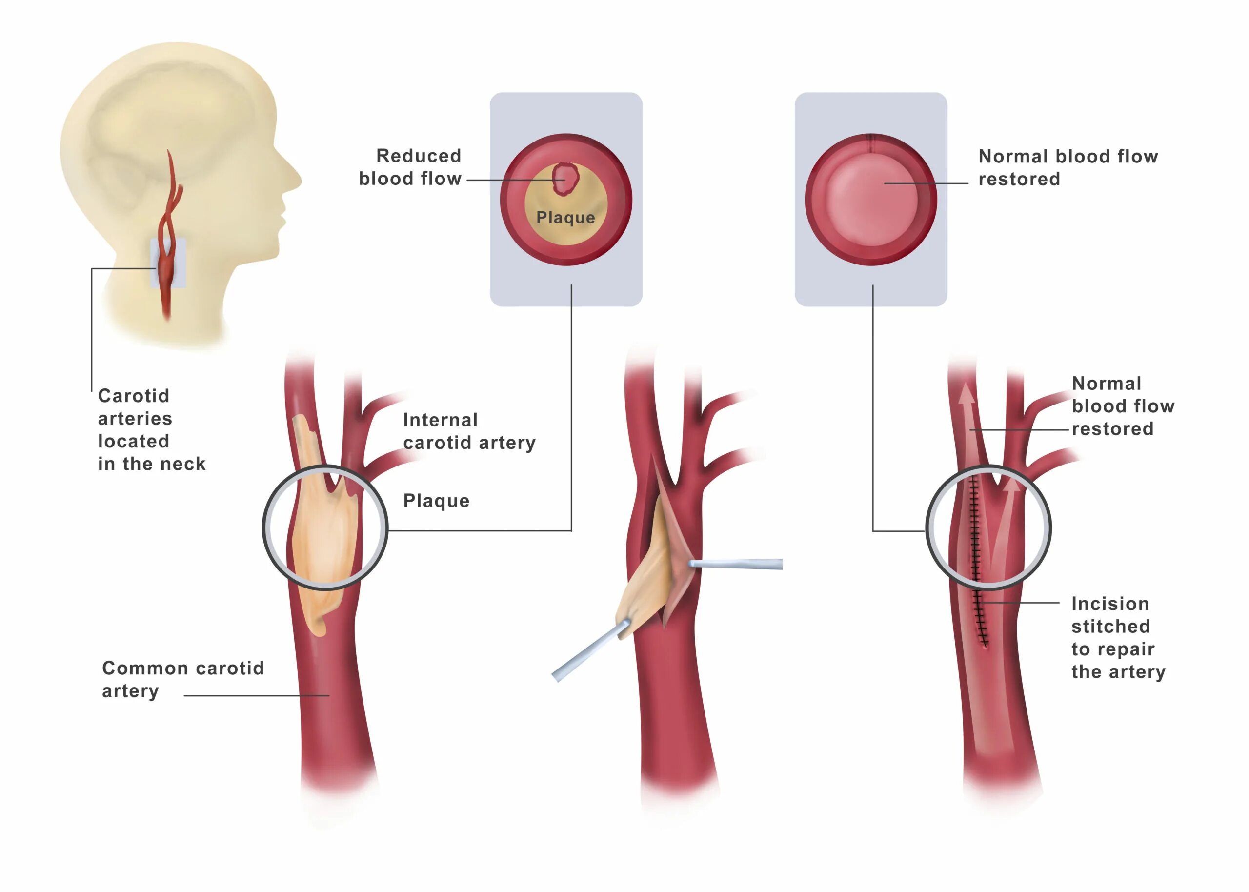 Каротидная эндартерэктомия. Операция каротидная эндартерэктомия. Carotid artery утвфкеукусещьш. Каротидная эндартерэктомия нейрохирургия. Эверсионная каротидная эндартерэктомия