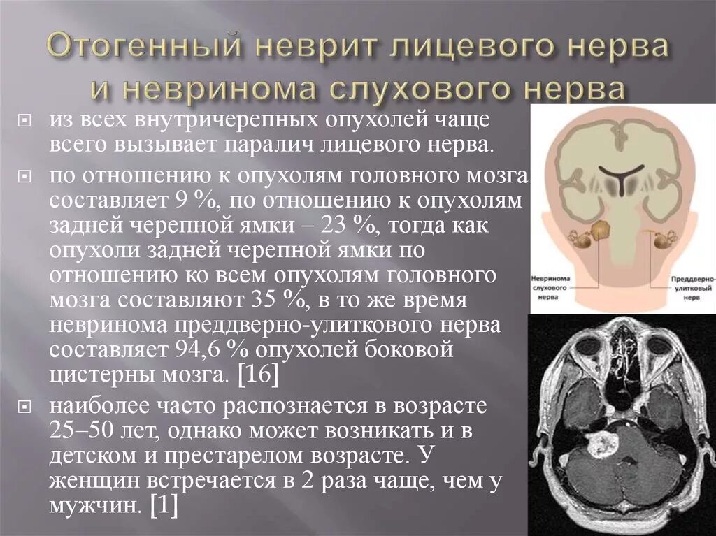 Поражение слухового нерва. Невринома слухового нерва опухоль. Шваннома слухового нерва симптомы. Невринома слухового нерва операция. Неврит слухового нерва на мрт.