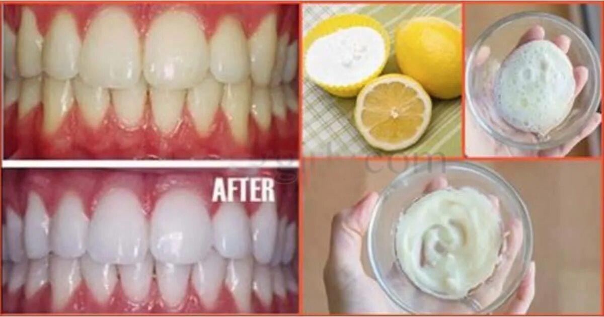 Разрешенные продукты после отбеливания зубов. Отбеливание зубов. Зубы окрасились после отбеливания. Зубы до и после отбеливания.