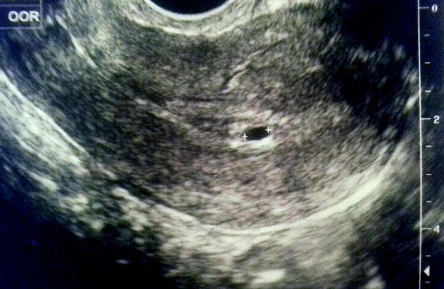 Месячные начинаются эндометрий. УЗИ матки перед месячными.