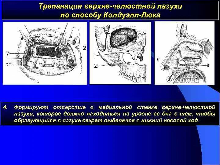 Операция люка. Схема операции по Колдуэллу-люку. Операция на верхнечелюстной пазухе по Колдуэллу-люку. Радикальная операция на верхнечелюстной пазухи. Методика гайморотомии по Колдуэллу-люку..