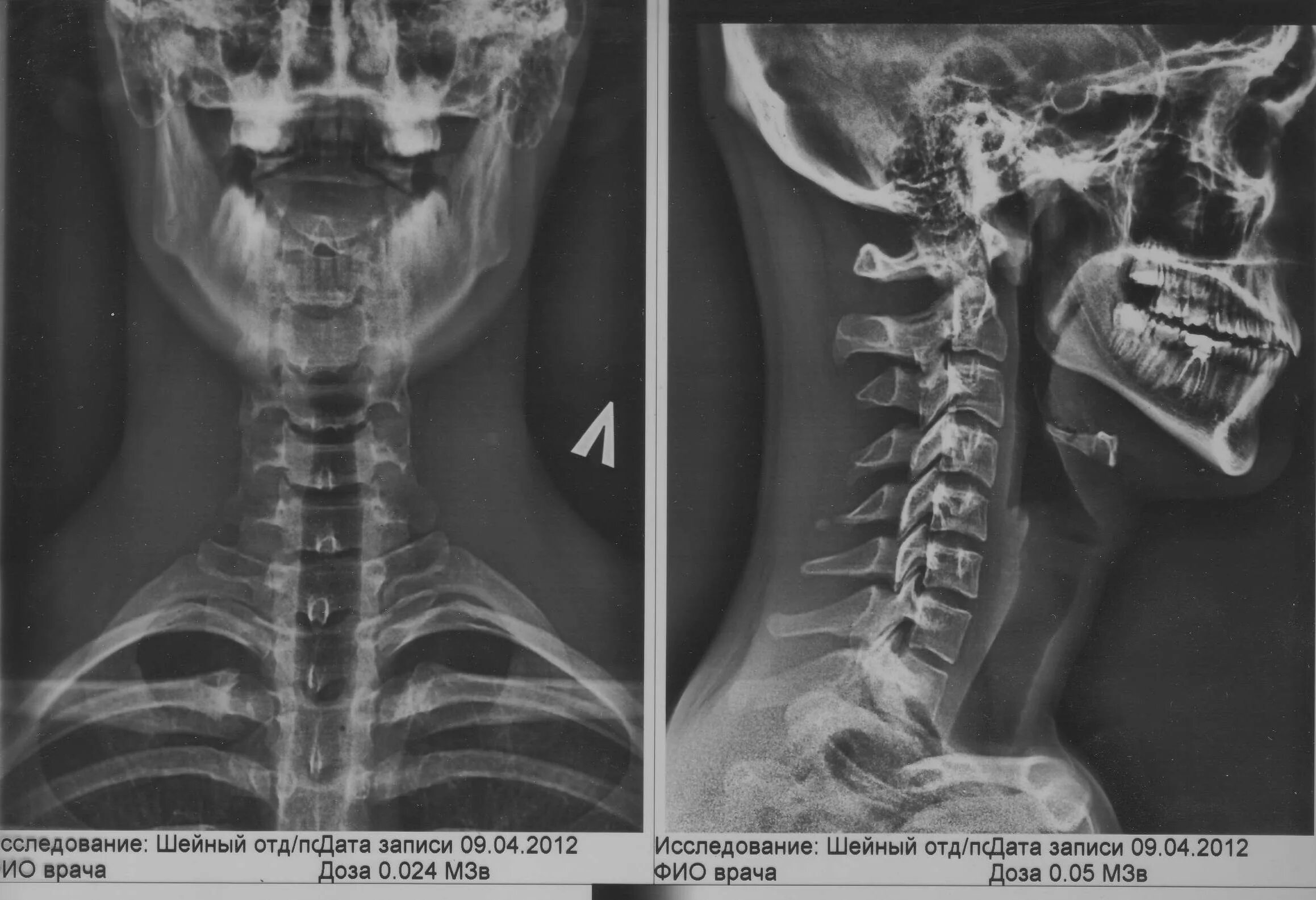Остеохондроз шейного отдела позвоночника с3-с6. Шейные позвонки с2 с6. Шейный отдел рентген шейный остеохондроз. Нестабильность с3 с4 шейных позвонков. Остеохондроз с7