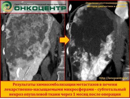 Метастазы в печени прогноз 4 стадия выживаемость