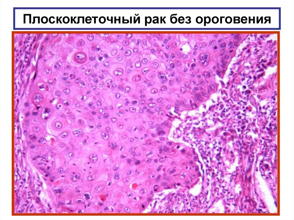 Плоскоклеточный неороговевающий рак матки. Плоскоклеточная карцинома матки микропрепарат. Плоскоклеточная карцинома шейки матки гистология. Раковые Жемчужины микропрепарат. Плоскоклеточная неороговевающая карцинома кожи.