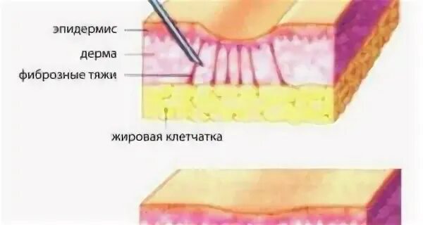 Удаление фиброзов
