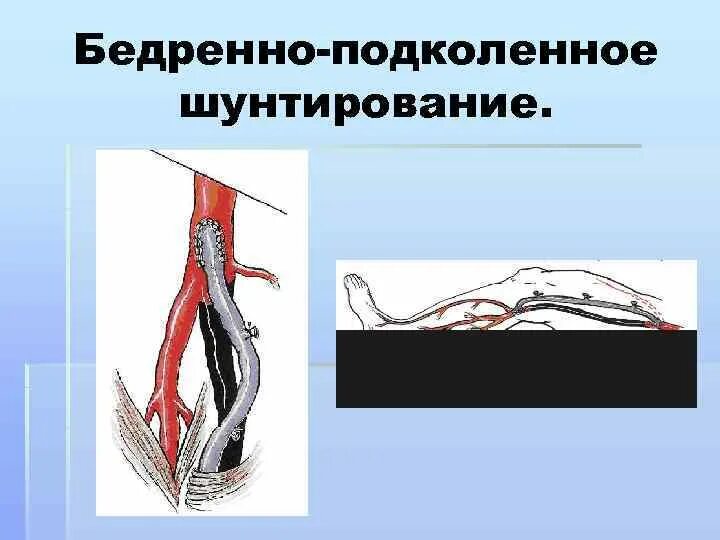 Техника операции бедренно подколенного шунтирования. Проксимальное бедренно подколенное шунтирование. Шунтирование периферических артерий. Шунтирование сосудов нижних конечностей. Операция на сосудах нижних конечностей