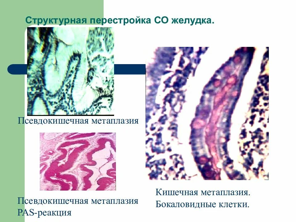 Кишечная метаплазия желудка гистология. Метаплазия эпителия желудка. Метаплазия клеток Панета. Кишечная метаплазия гистология. Полная метаплазия желудка