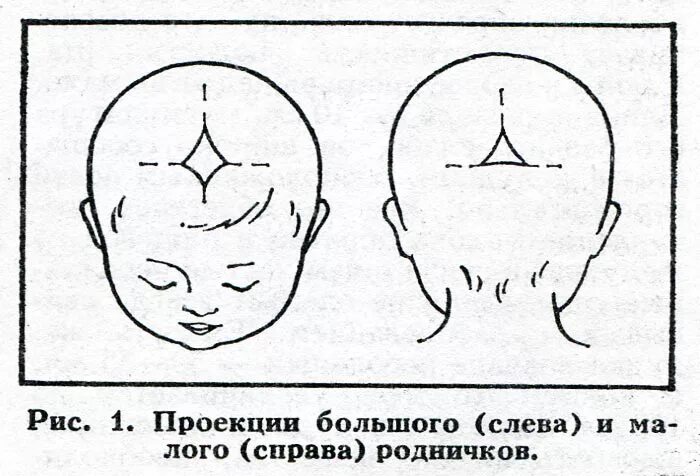 Большой и малый Родничок у новорожденного. Форма малого родничка у новорожденного. Родничок и темечко у новорожденных. Норма темечки у младенцев.