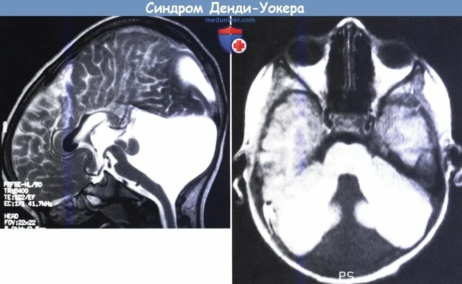 Денди уокера мрт. Гипоплазия мозжечка, аномалия денди-уокера. мальформация денди уокера мрт. вариант аномалии денди-уокера. ретроцеребеллярная киста мрт.