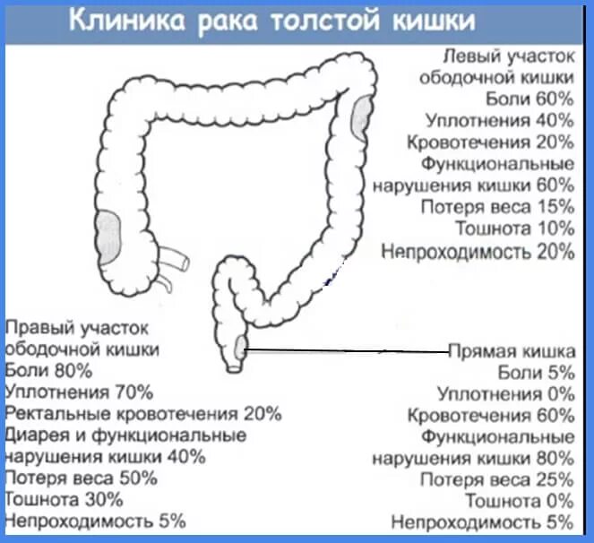 Симптомы рака кишки. Опухоли Толстого кишечника клиника. Опухоль восходящего отдела толстой кишки. Опухоли прямой кишки клиника. Опухоль Толстого кишечника симптомы.